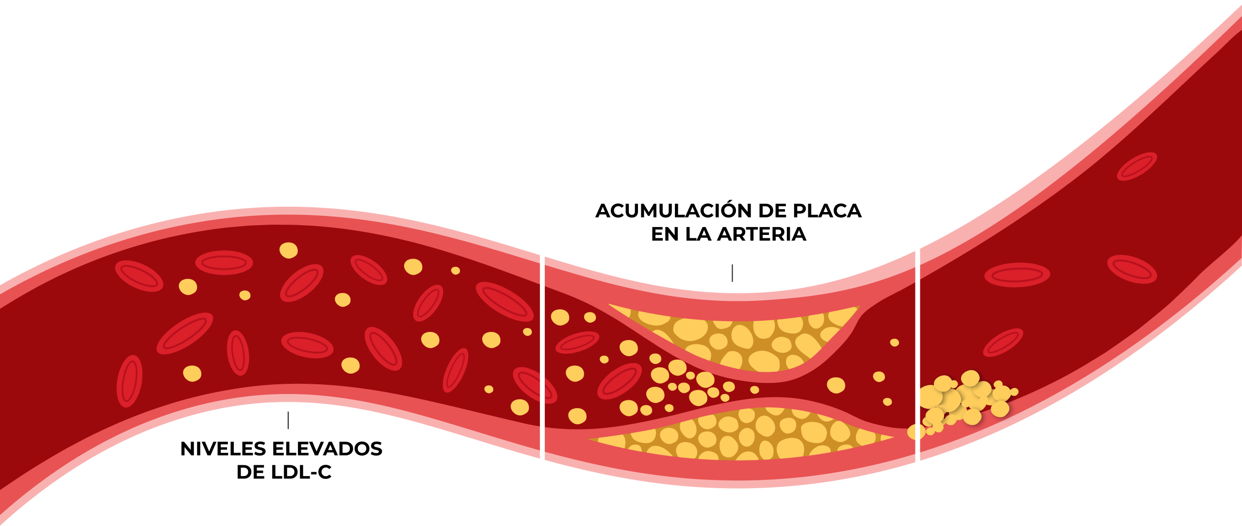 Acumulacion de placa en la arteria