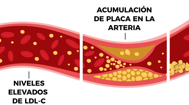 Acumulacion de placa en la arteria